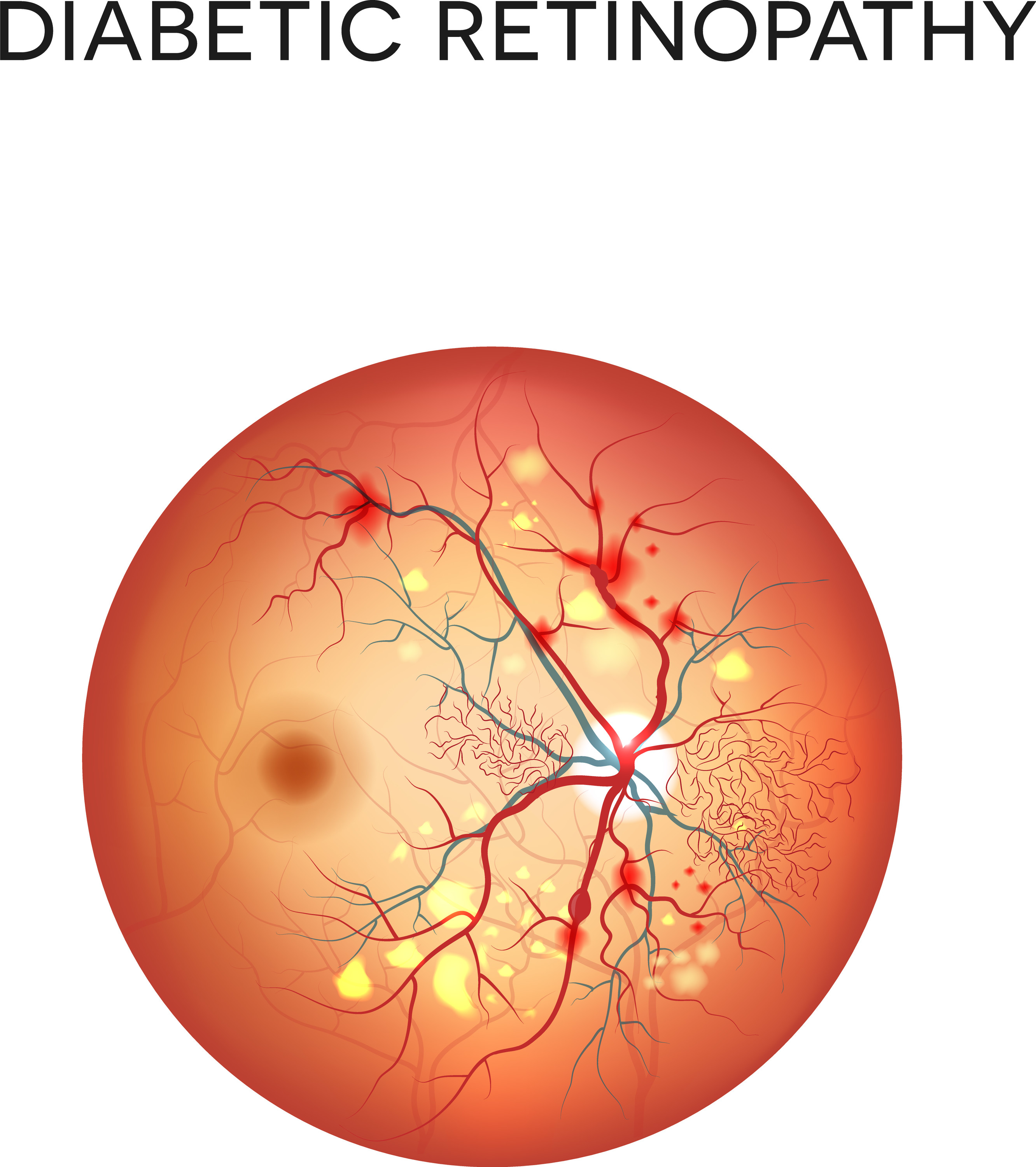 Diabetic Retinopathy Skyline Vision Eye Disease Colorado Springs